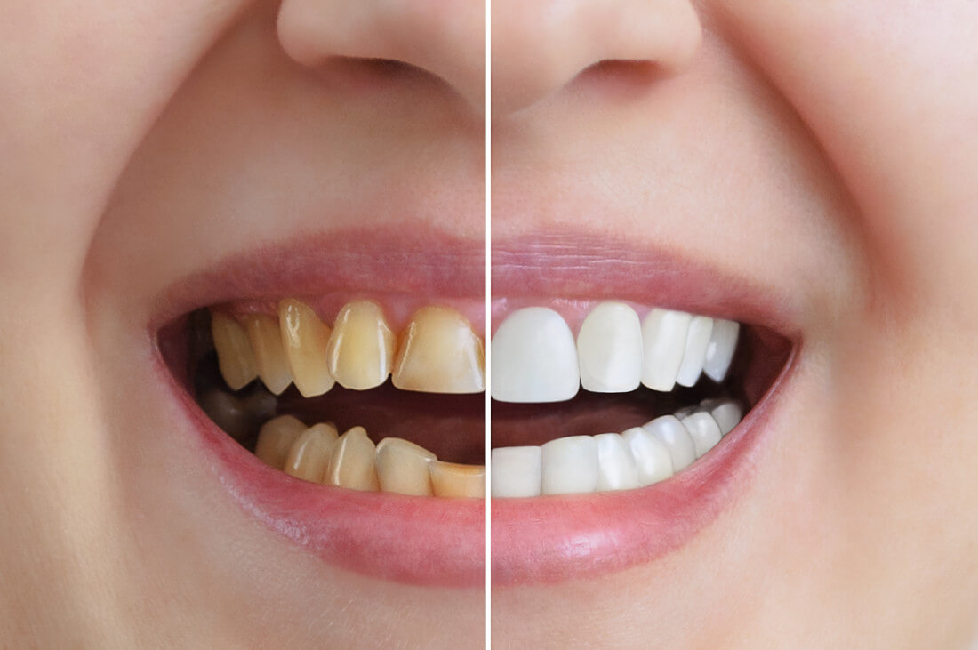 Vorher-Nachher-Bild von behandelten Zähnen, eine Hälfte gelb, die andere weiß.